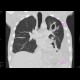 Lung cavity, pneumothorax, hydropneumothorax: CT - Computed tomography